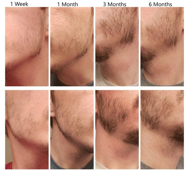 beard not growing on jaw - Minoxidil