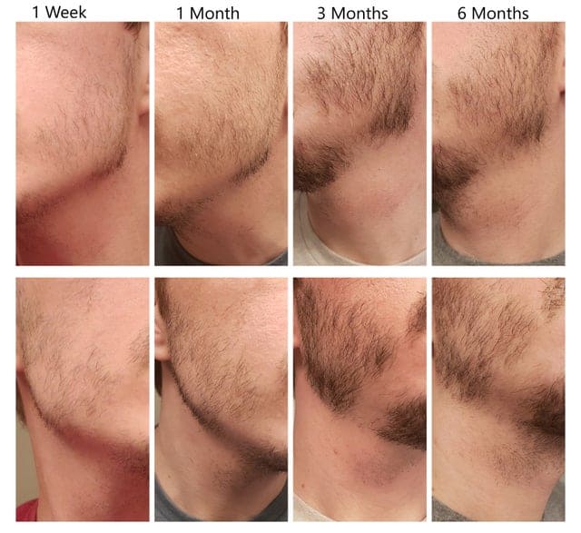 Some Men Cant Grow Beards and Facial Hair a Dermatologist Explains