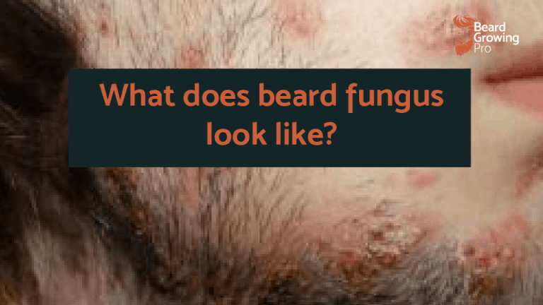 what does beard fungus looked like