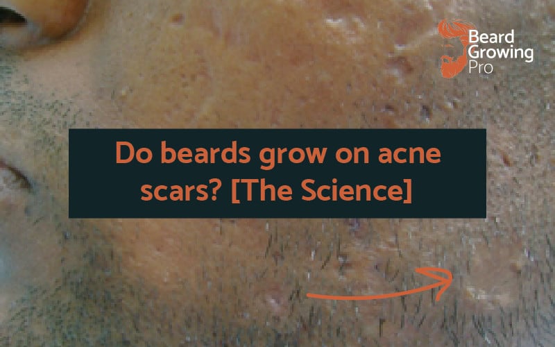 Do beards grow on acne scars? [The science you need to know]